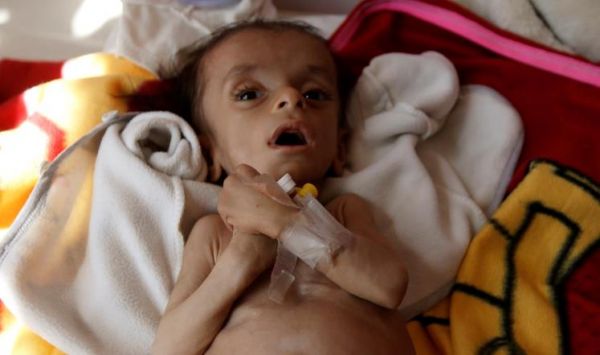 الأمم المتحدة تخصص 18 مليون دولار لمنع المجاعة في اليمن