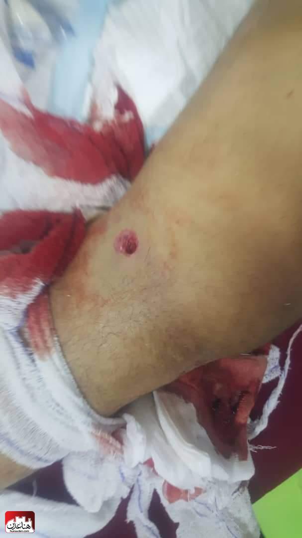 شاهد صورة: سقوط اول جريح في عدن برصاص قوات تابعة للمجلس الانتقالي الجنوبي 