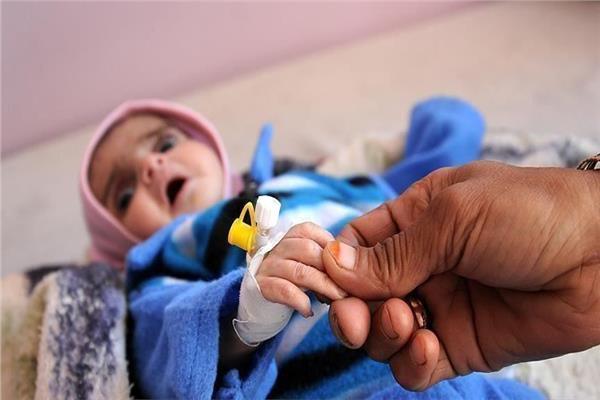 الأمم المتحدة: 2.2 مليون طفل يمني بحاجة إلى علاج من سوء التغذية الحاد